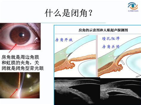 房角|闭角型青光眼